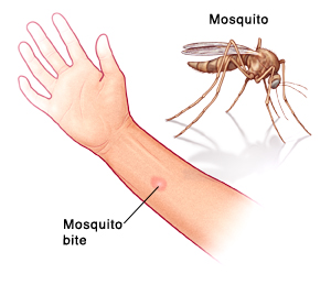 Mosquito Bite